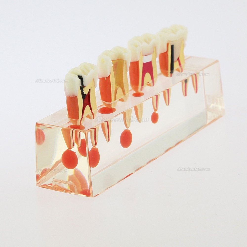 Dental Teeth Study Model 4-Stage Endodontic Treatment Model 4018 01