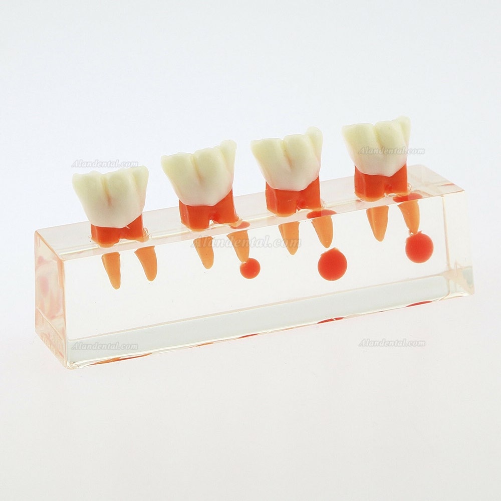 Dental Teeth Study Model 4-Stage Endodontic Treatment Model 4018 01