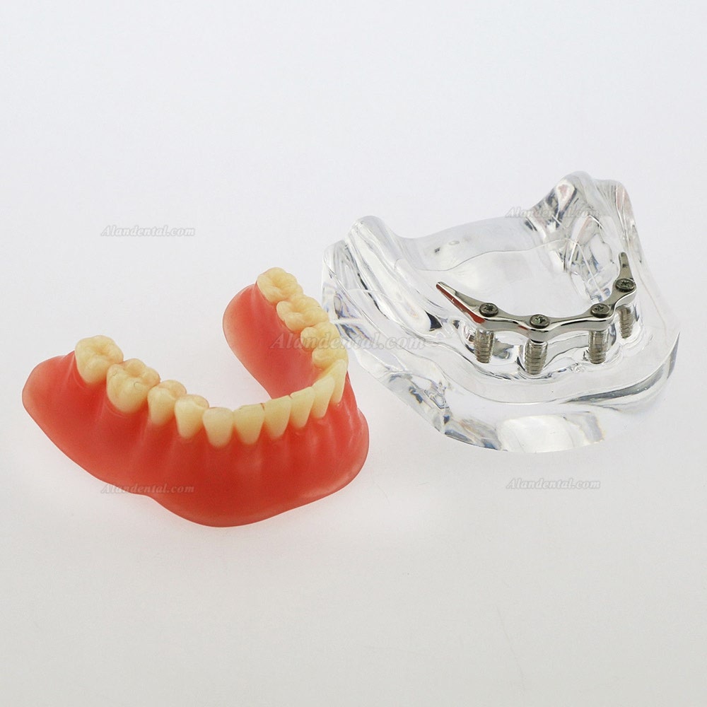 Dental Inferior Teeth Model Overdenture Precision 4 Implants Demo Silver Bar