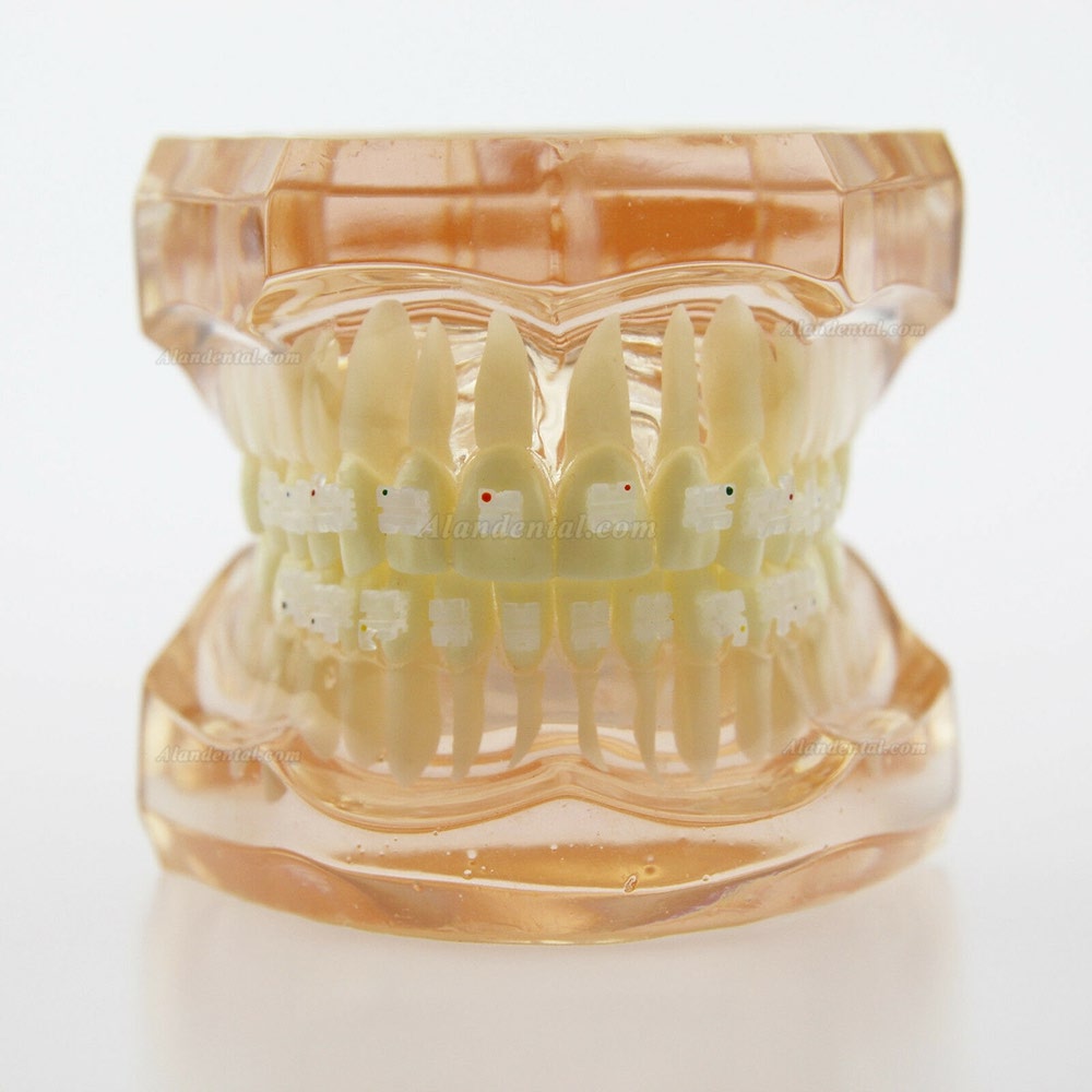 Dental Orthodontics Treatment Model Demo Teeth Ceramic/Metal Brackets