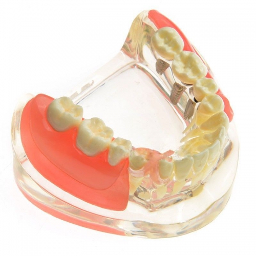 M-6006 Dental Model Contrast Implant Restoration for Missing Molar Teeth