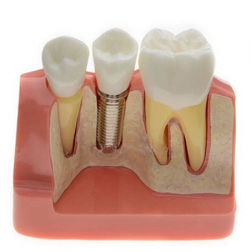 Model Analysis for Dental Implant M2017