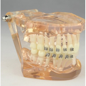 Dental Orthodontic Model with Ceramic Brackets M3009