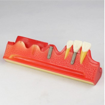 Dental Implant Demonstration Show Model M2018