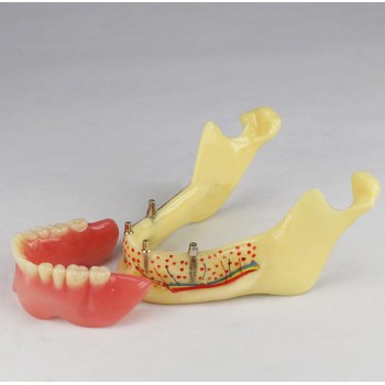 Dental Teeth Implant Model Of Jaw M-2014b