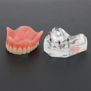 Dental Study Teeth Model Overdenture Superior With 4 Implants Demo Model 6001