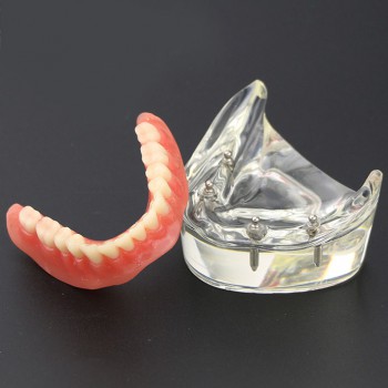 Dental Lower Teeth Demo Study Model 6002 02 Overdenture Inferior 4 Implants