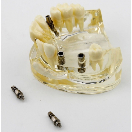 Dental Upper Jaw Implant Surgery Study Dem Model 2005