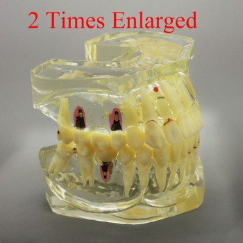 2 times Enlarged Dental Restoration/ Prothesis/Implant Study model with Bridge