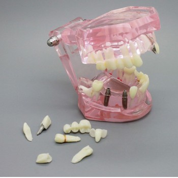 Dental Implant Study Analysis Demonstration Teeth Model with Restoration 2001 Pi...