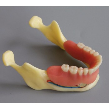 Dental Model #2014 02 - Mandible Implant and Overdenture Demo Model (Yellow)