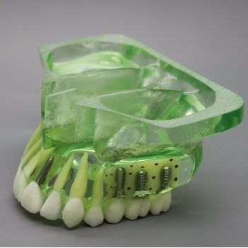 Dental Model 2015 01 Upper Jaw Implant Model with Sinus