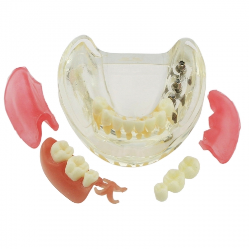 Dental Teeth Model Inferior Removable Restoration Implant Bridge Demo Model 6006