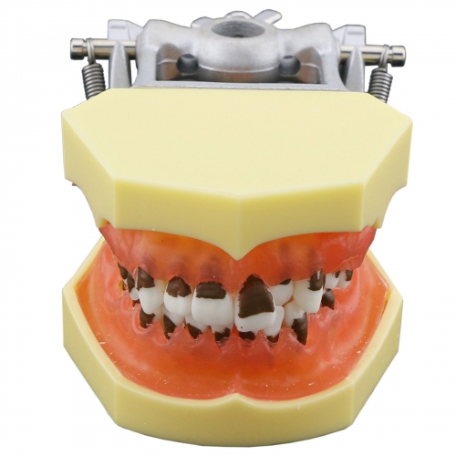 Dental Periodontosis Disease Model Demonstrates Inflamed Gingivae Calculs 4003