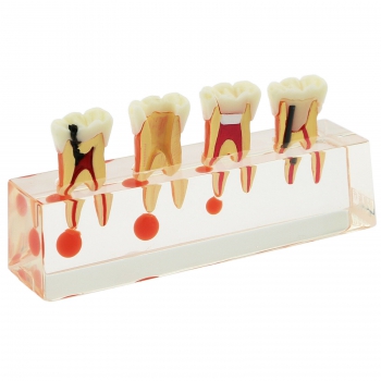 Dental Teeth Model 4-Stage Endodontic Treatment Study Teach Model 4018 01