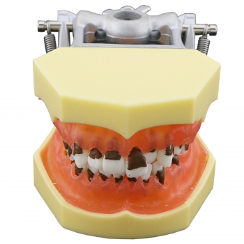 Dental Periodontosis Disease Model Demonstrates Inflamed Gingivae Calculs 4003