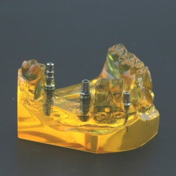 Dental Implant Typodont Superior Teeth Model Upper Jaw Demo Model #201102