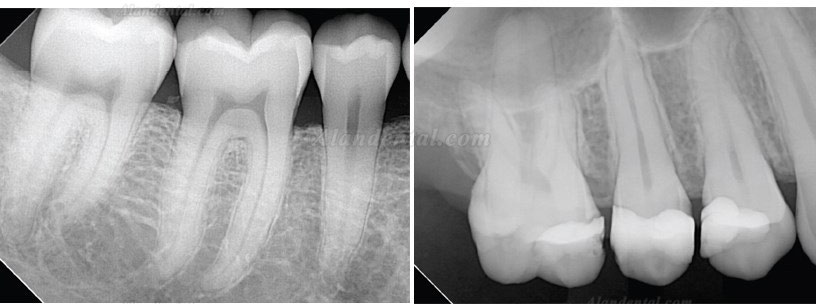 High Resolution Digital USB Type Dental X Ray Sensor Rvg