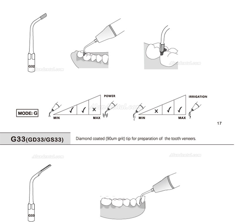 5Pcs Refine® Ultrasonic Scaling Tips G20 G21 G30 G31 G32 G33 G35 Compatible with REFINE EMS Woodpecker Scaler Handpiece