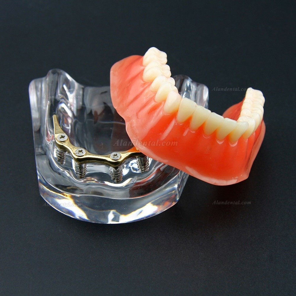 Dental Overdenture Typodont Model Inferior Precision Implant Golden 6009