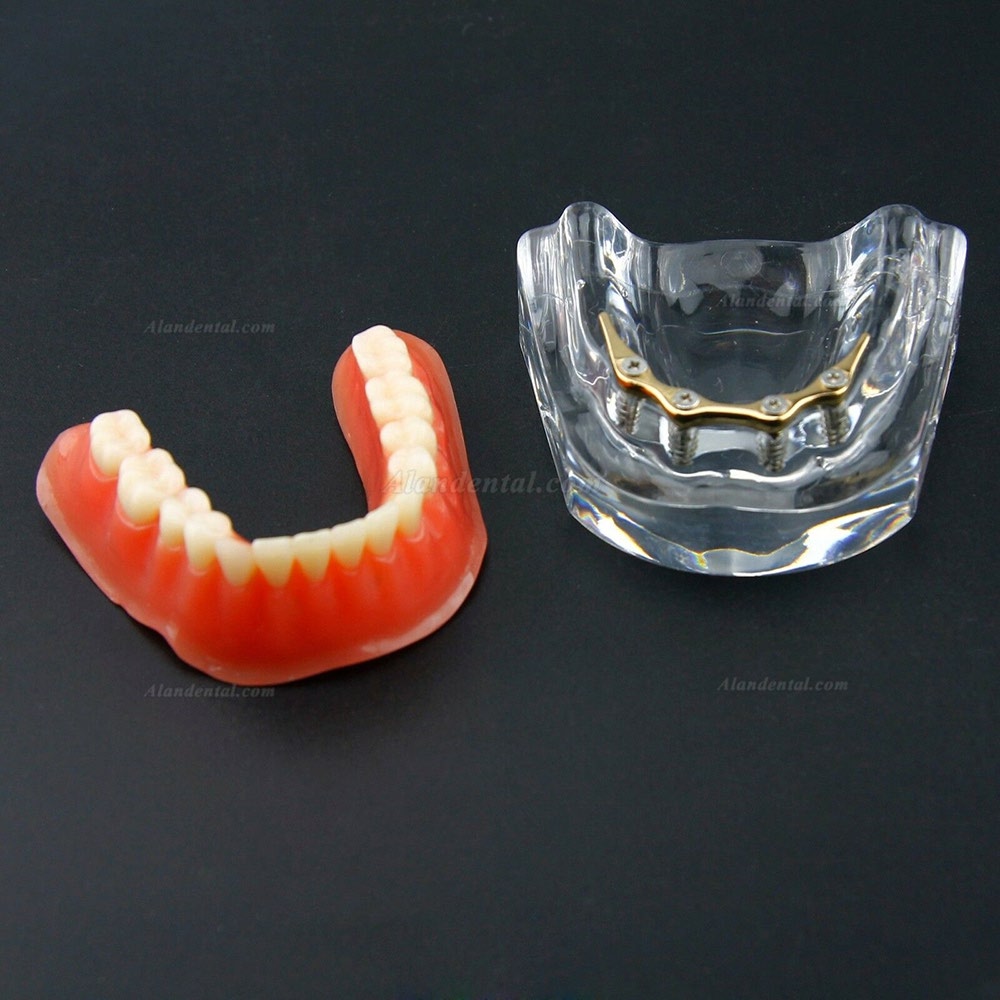 Dental Overdenture Typodont Model Inferior Precision Implant Golden 6009