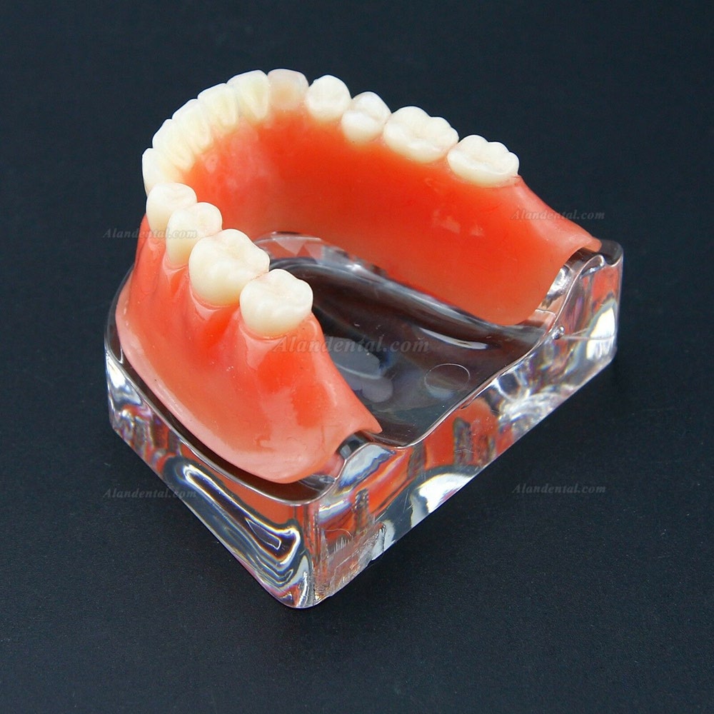 Dental Overdenture Typodont Model Inferior Precision Implant Golden 6009