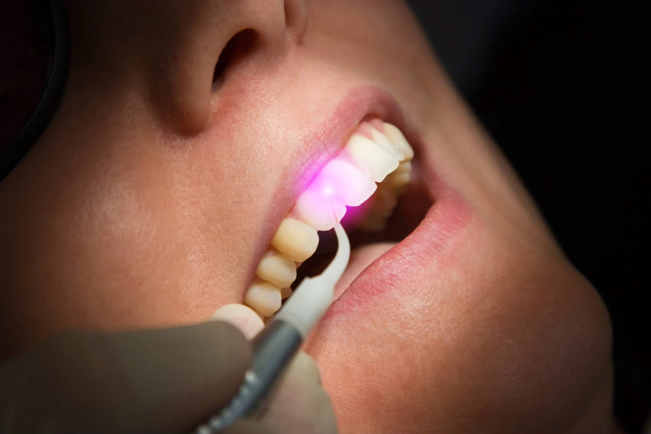 Gigaalaser Cheese Plus CP13G Dental Multi-Wavelength Diode Laser System 635nm+445nm+1064nm
