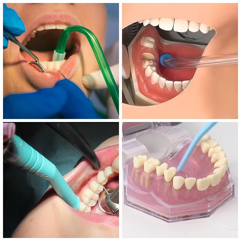 Dental Micro Negative Pressure System
