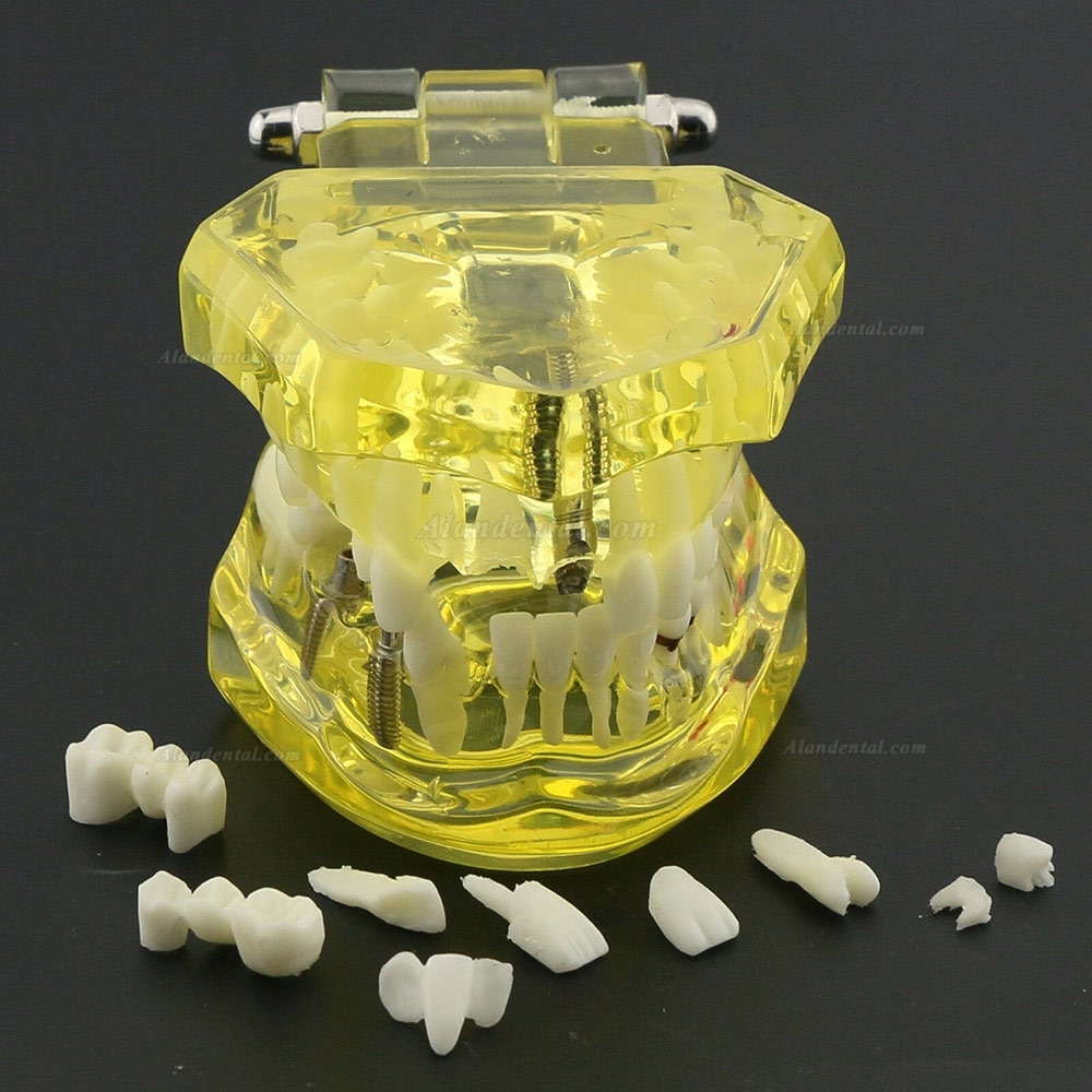 Dental Teeth Model Teach Study Oral Implant Restoration & Pathology 2001 Yellow