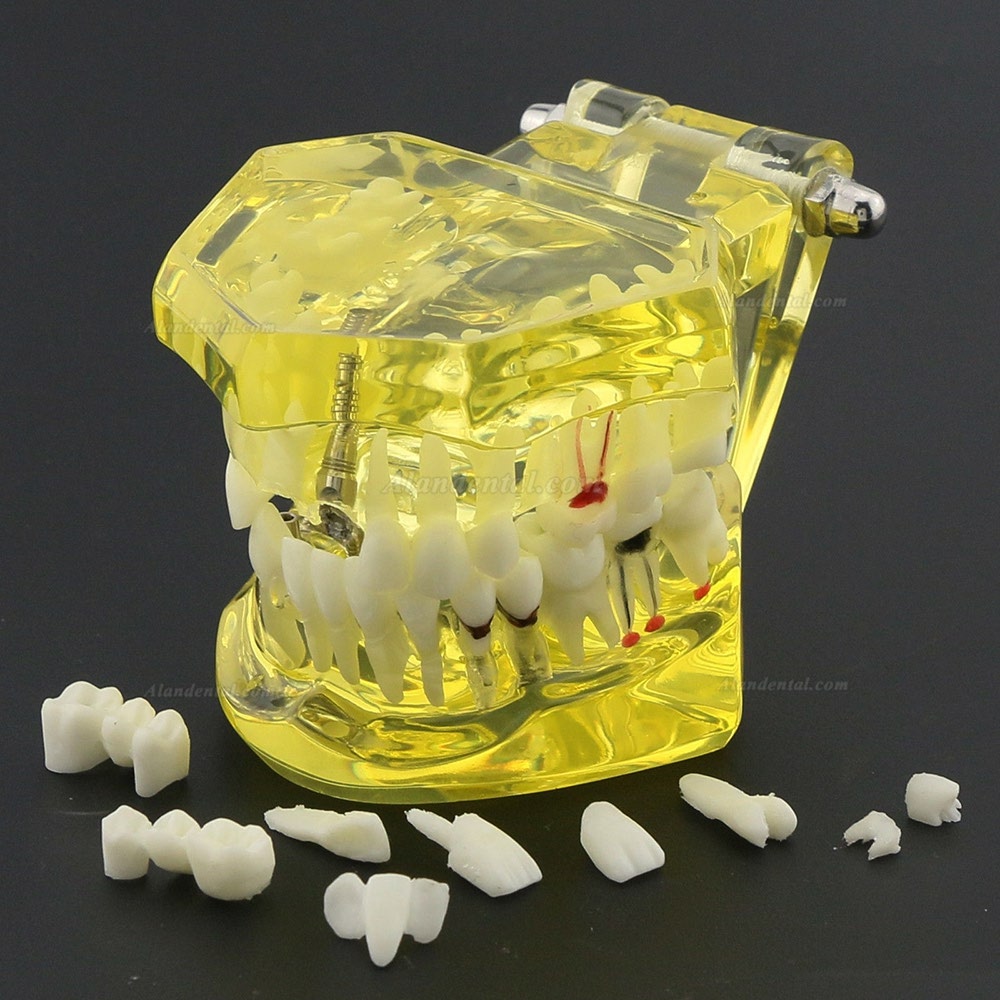 Dental Teeth Model Teach Study Oral Implant Restoration & Pathology 2001 Yellow