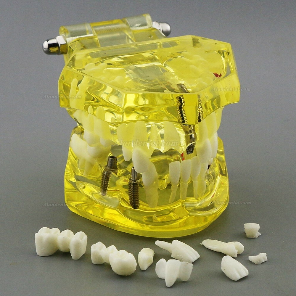 Dental Teeth Model Teach Study Oral Implant Restoration & Pathology 2001 Yellow