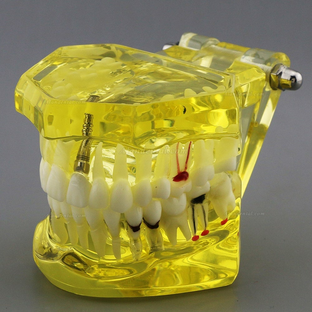 Dental Teeth Model Teach Study Oral Implant Restoration & Pathology 2001 Yellow