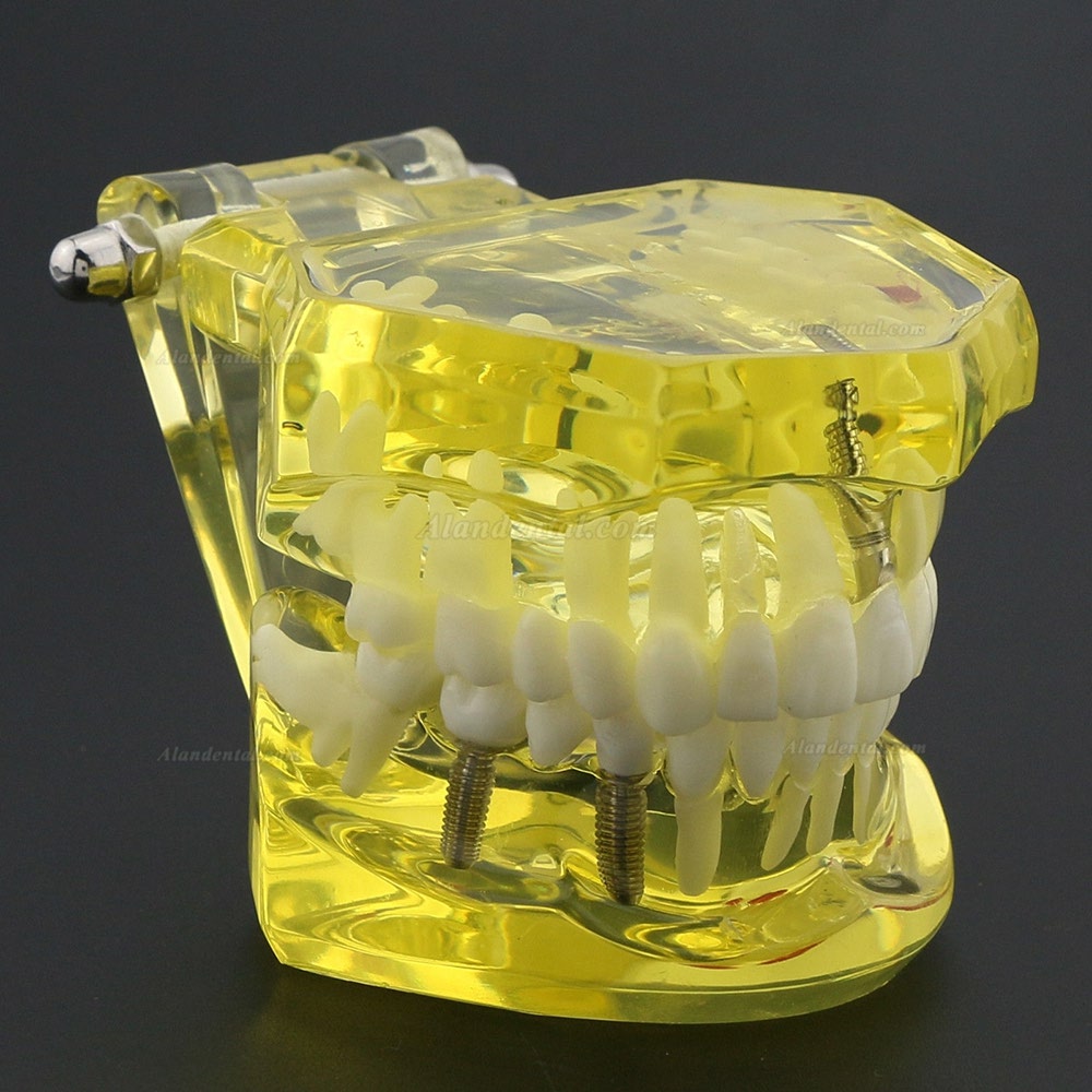 Dental Teeth Model Teach Study Oral Implant Restoration & Pathology 2001 Yellow