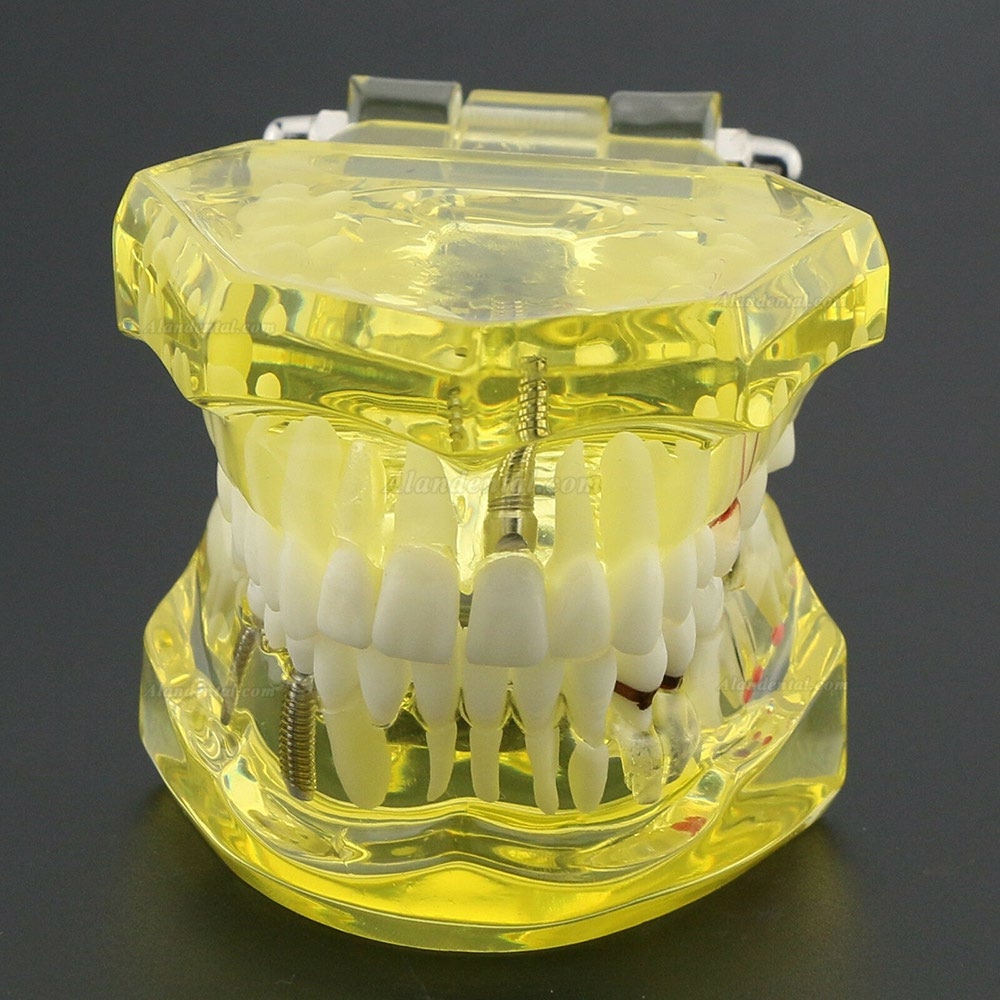 Dental Teeth Model Teach Study Oral Implant Restoration & Pathology 2001 Yellow