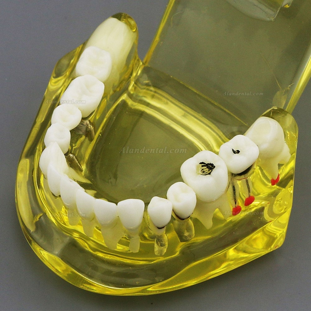 Dental Teeth Model Teach Study Oral Implant Restoration & Pathology 2001 Yellow