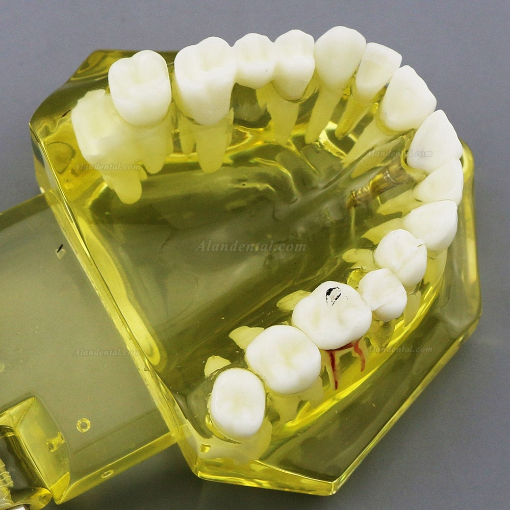 Dental Teeth Model Teach Study Oral Implant Restoration & Pathology 2001 Yellow