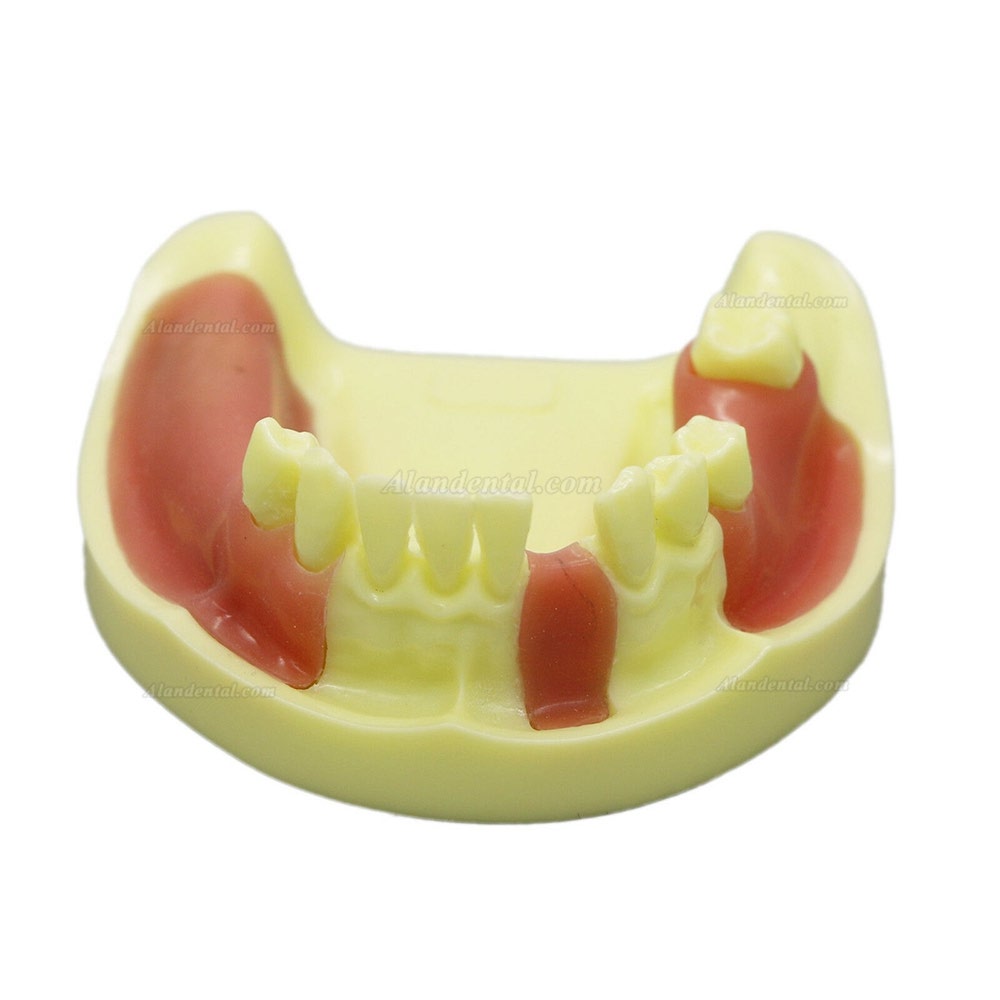Dental Model #2004 01 - Lower Jaw Implant Practice Model with Gingiva