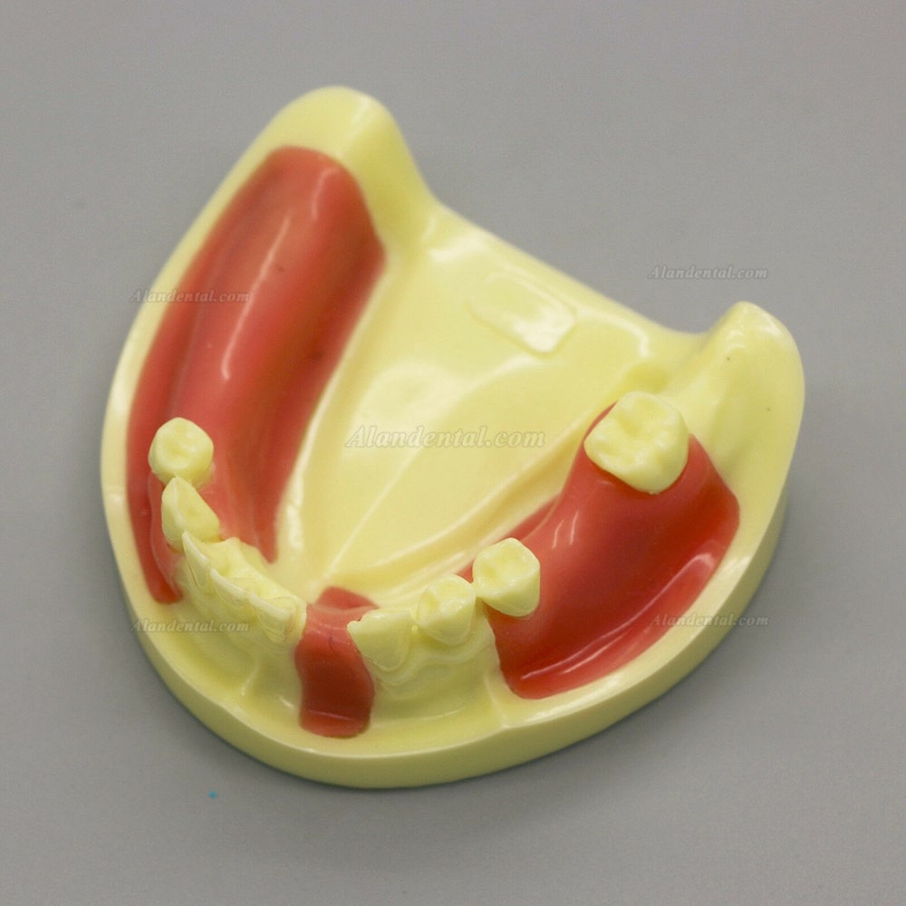 Dental Model #2004 01 - Lower Jaw Implant Practice Model with Gingiva