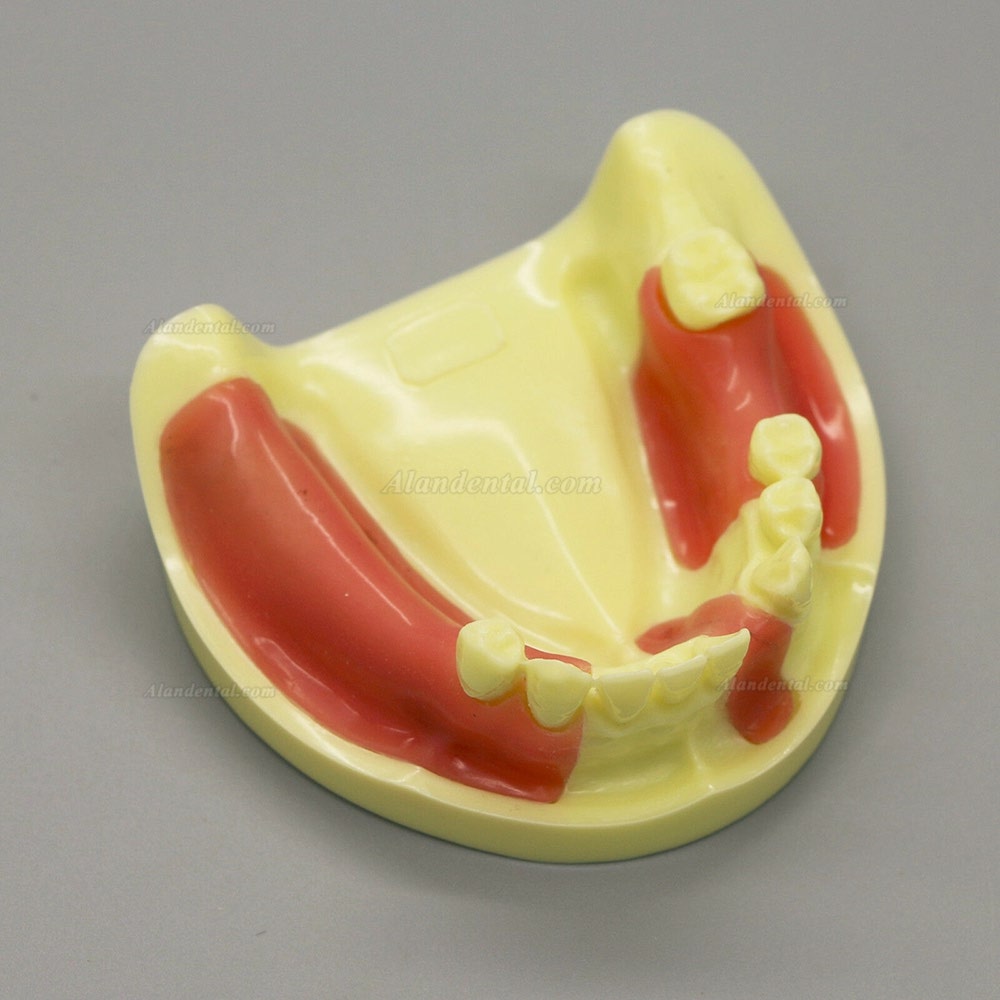 Dental Model #2004 01 - Lower Jaw Implant Practice Model with Gingiva