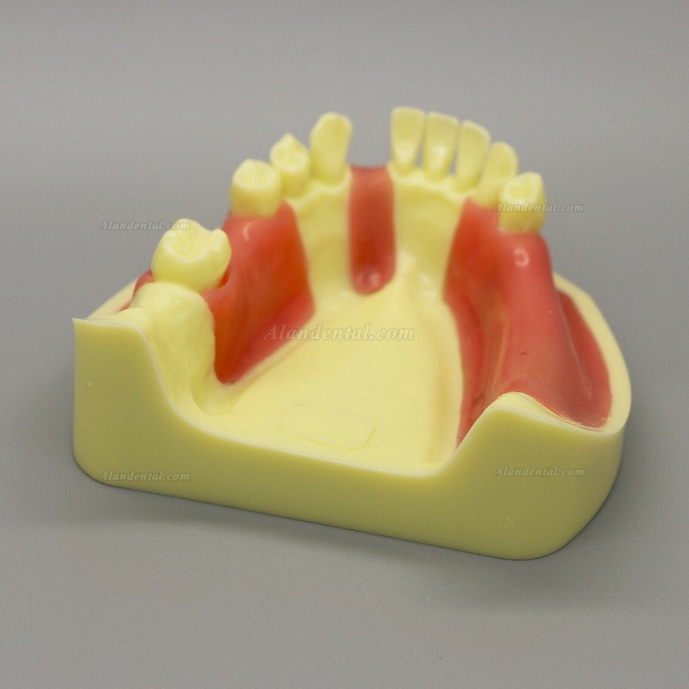 Dental Model #2004 01 - Lower Jaw Implant Practice Model with Gingiva