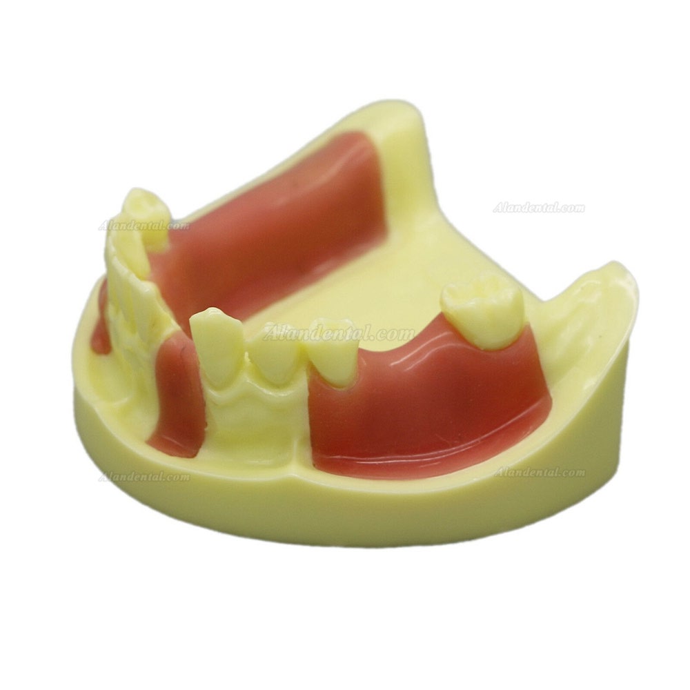 Dental Model #2004 01 - Lower Jaw Implant Practice Model with Gingiva