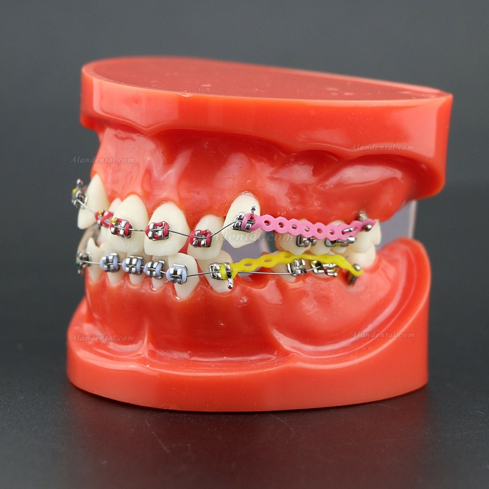 Dental Orthodontics Treatment Study Model With Metal Bracket Arch Wire Chain Tie