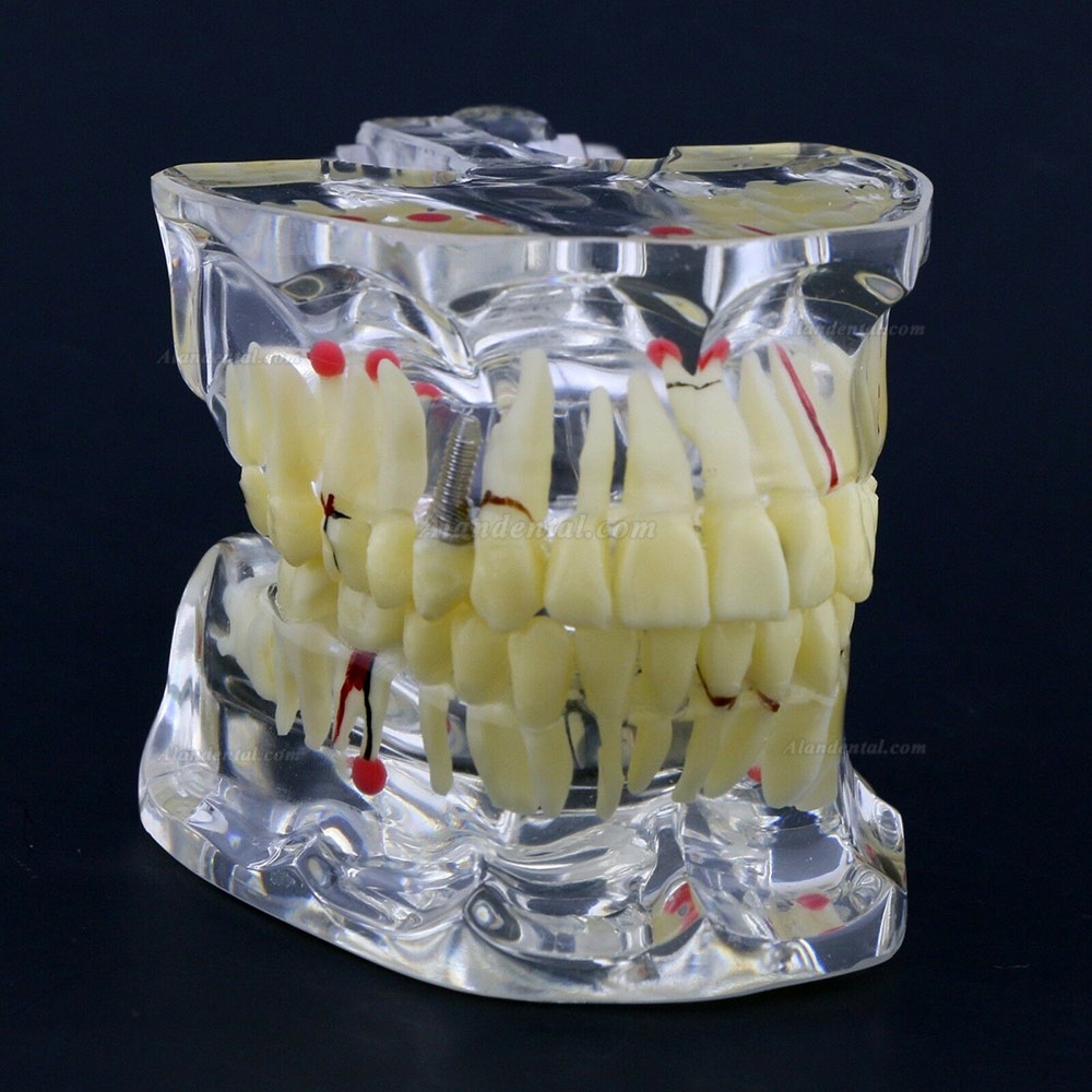 New Dental Teach Study General Adult Pathology Typodont Teeth Model #4001