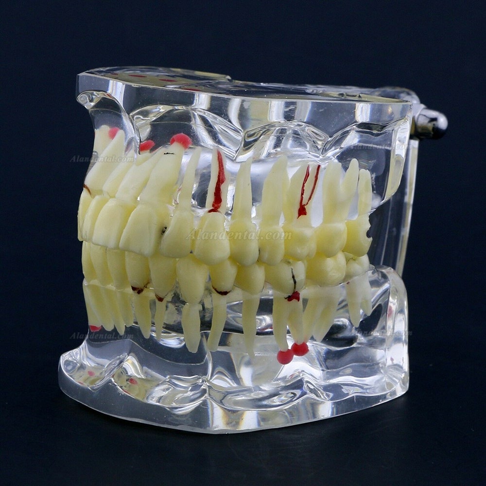 New Dental Teach Study General Adult Pathology Typodont Teeth Model #4001