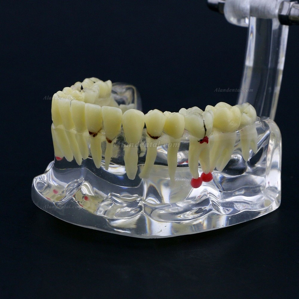 New Dental Teach Study General Adult Pathology Typodont Teeth Model #4001