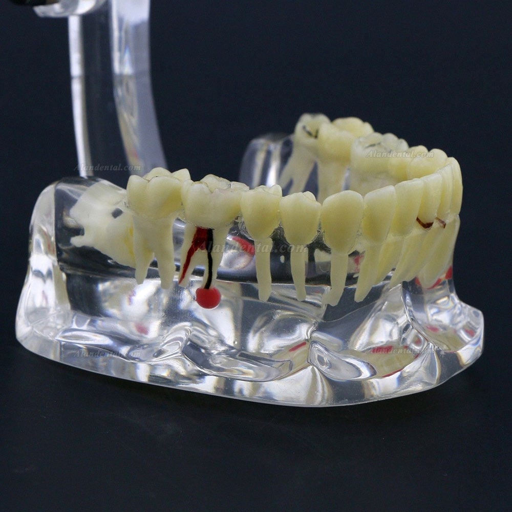 New Dental Teach Study General Adult Pathology Typodont Teeth Model #4001