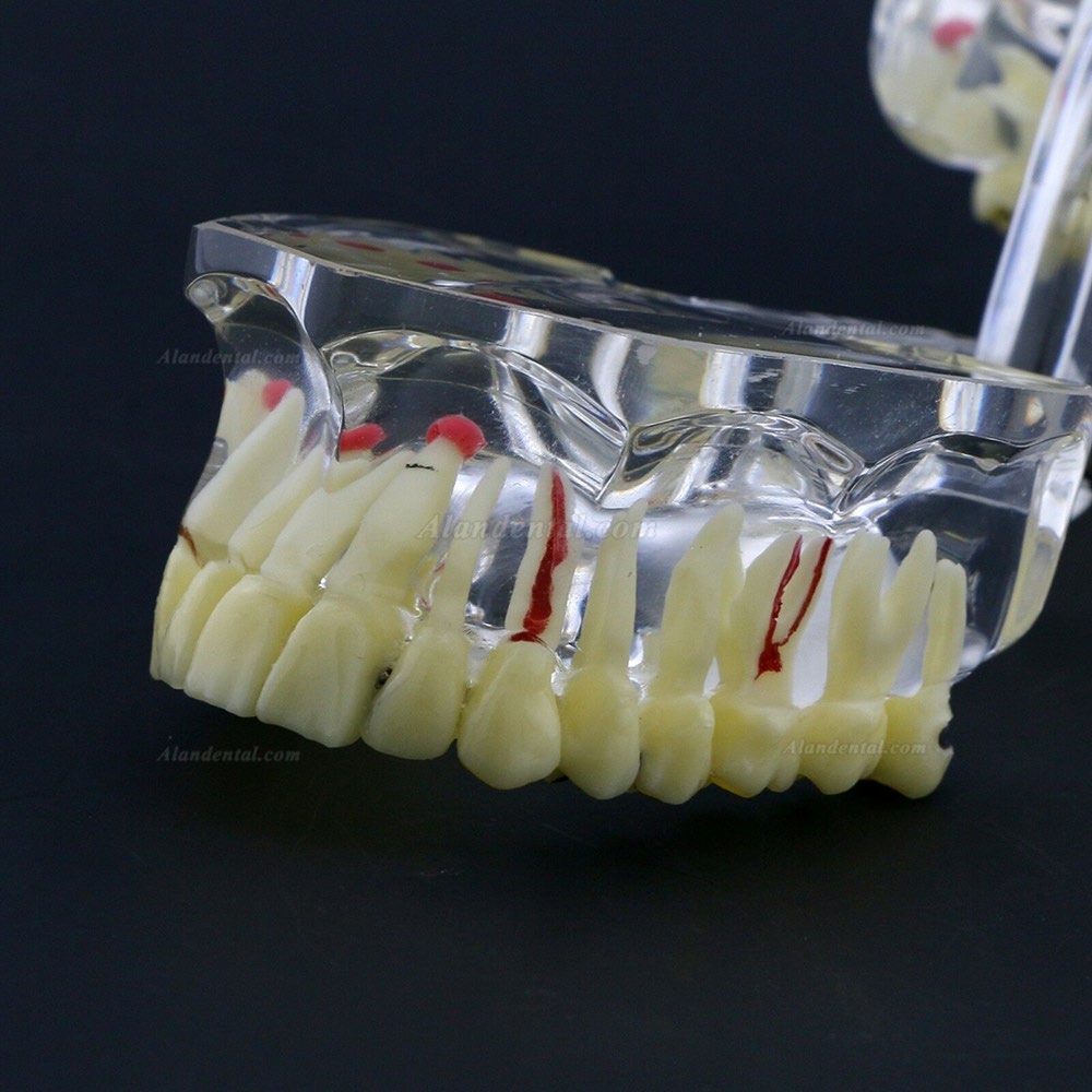 New Dental Teach Study General Adult Pathology Typodont Teeth Model #4001