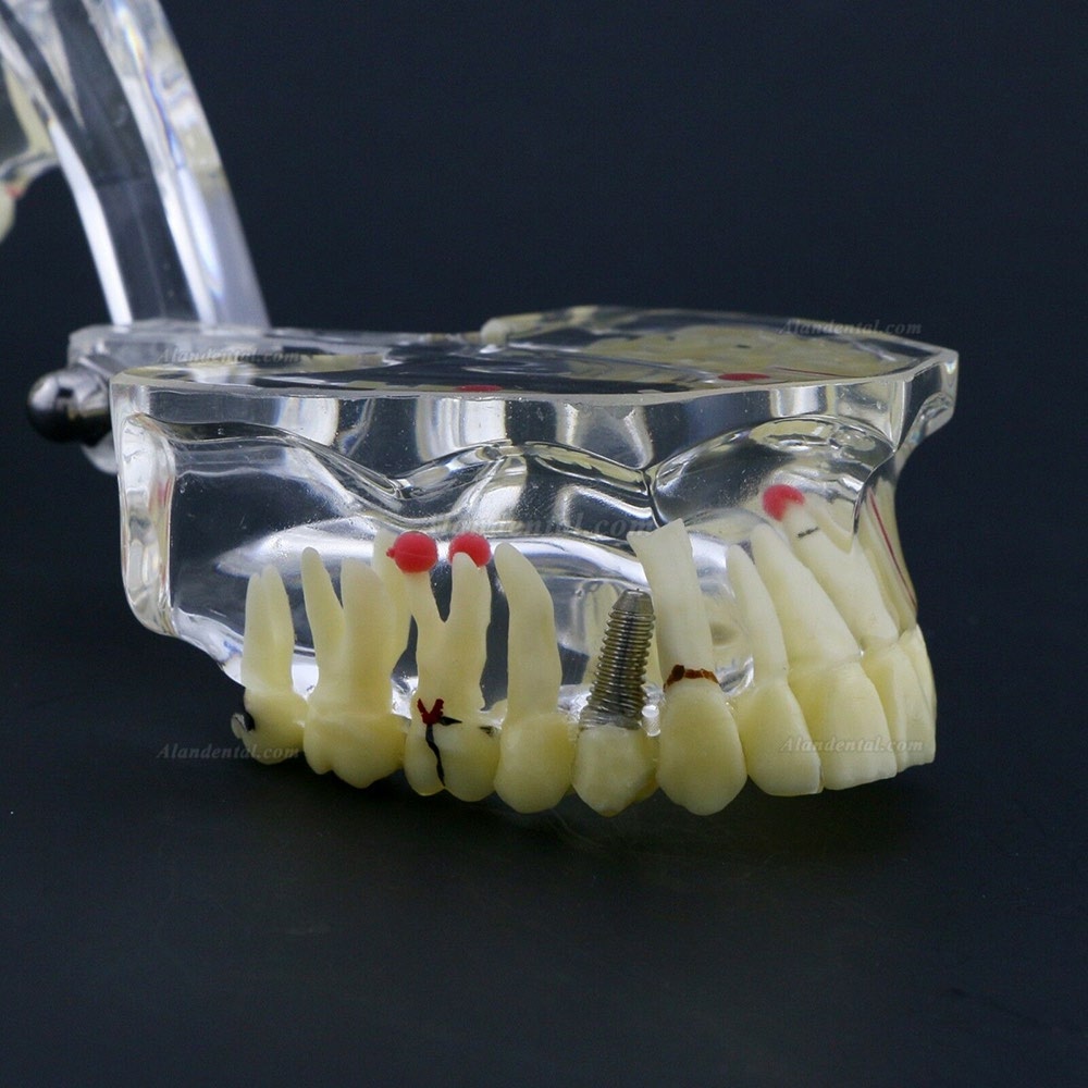 New Dental Teach Study General Adult Pathology Typodont Teeth Model #4001