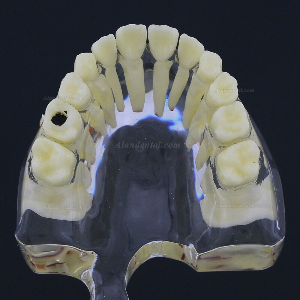 Dental Children Teeth Model Pediatric Pathology Demonstration Study Model 4002