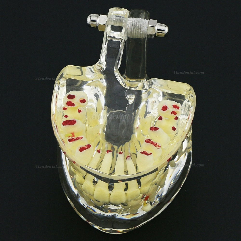 Dental Children Teeth Model Pediatric Pathology Demonstration Study Model 4002